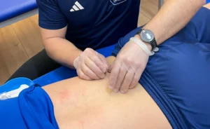 Dry Needling Quadratus lumborum